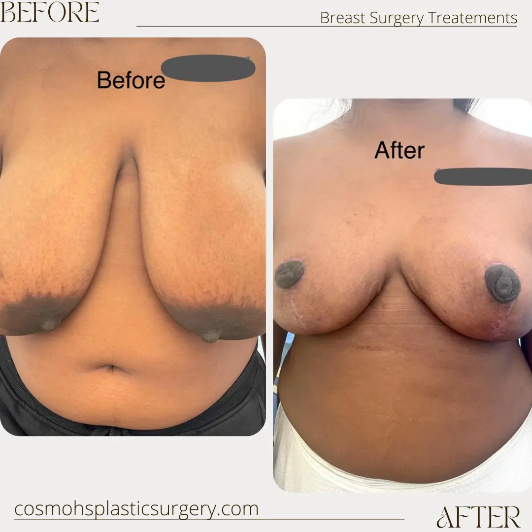 Breast reduction surgery and Treatment Overview